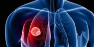 دراسة روسية: فيتامين B1  يساعد على علاج سرطان الرئة