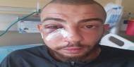 إصابة شاب بكسر في الوجه جراء اعتداء الاحتلال عليه شمال القدس