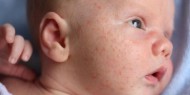 أسباب ظهور البقع الجلدية الحمراء لدى الأطفال