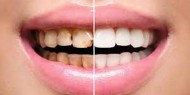 نصائح للوقاية من تلون الأسنان