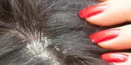 5 طرق طبيعية للتخلص من قشرة الشعر