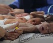 ارتفاع ضحايا سوء التغذية في قطاع غزة إلى 30 مواطنا